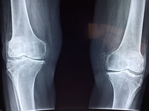knee-bone-x-ray